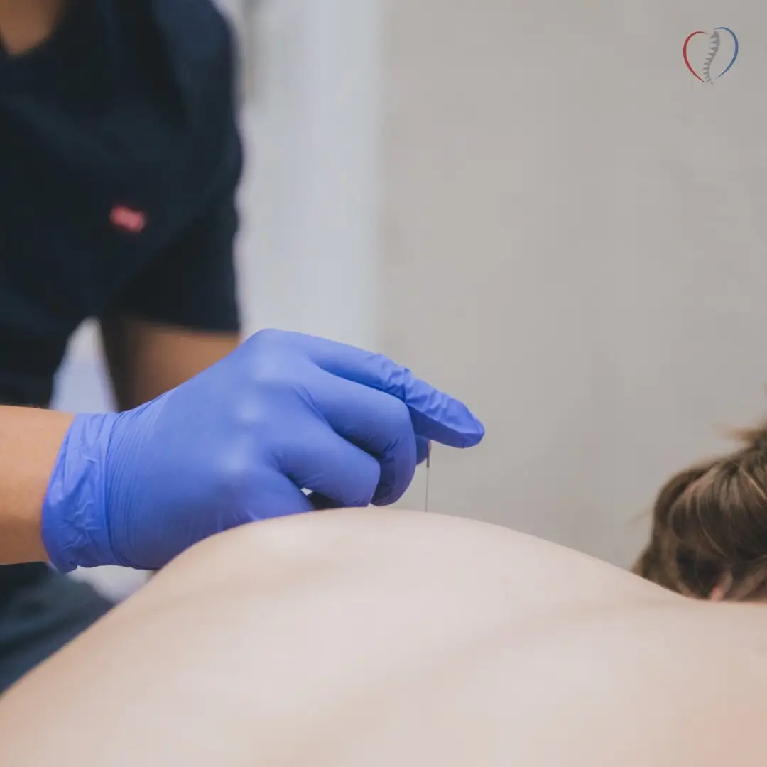 suche igłowanie (dry needling) jako skuteczne narzędzie w terapii bólu i napięć mięśniowych